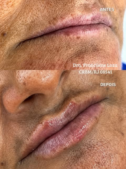 Resultado de procedimento labial na Clínica Loza